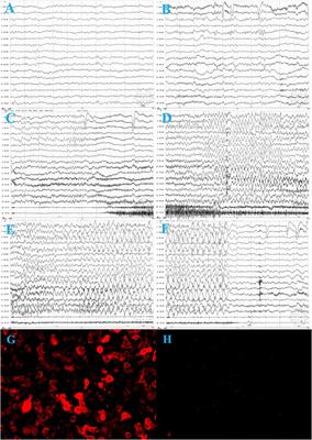 Case Report: Isolated Epileptic Seizures Associated With Anti-LGI1 Antibodies in a 7-Year-Old Girl With Literature Review